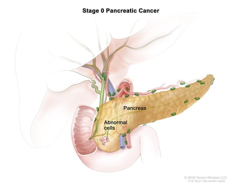pancreas cancer stage 0 medical illustration