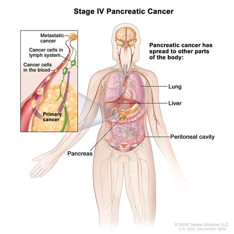 pancreatic-ca-stage-4